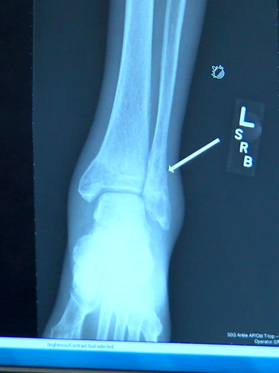 stress fracture
